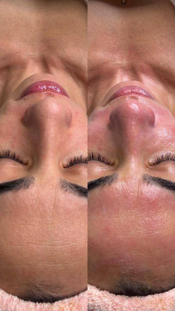 El tratamiento con Dermapen estimula la regeneración natural de la piel, mejorando su textura, firmeza y luminosidad.