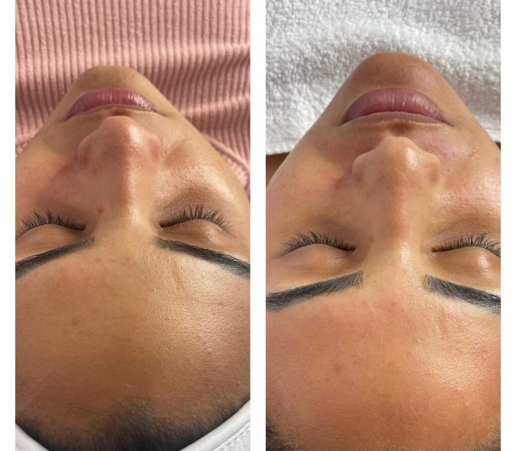 El dermaplaning es un tratamiento facial que elimina células muertas y vello fino, dejando la piel más suave, luminosa y uniforme.